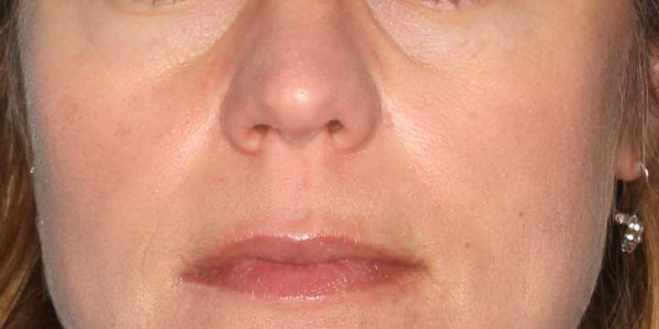 Before and after photos - Fill Under Eye Hollows