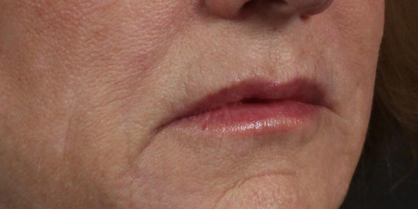 Before and after photos - Enhance Lip Border and Address Fine Lines Around the Lips