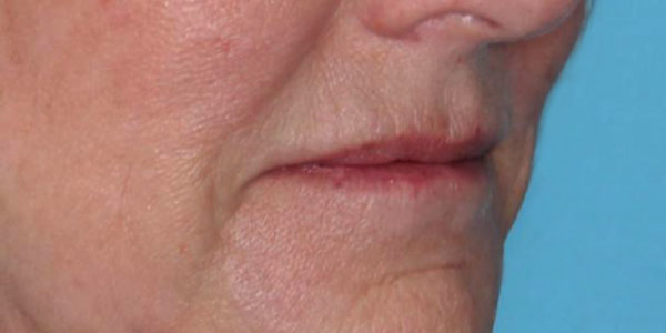 Before and after photos - Enhance Lip Border and Address Fine Lines Around the Lips