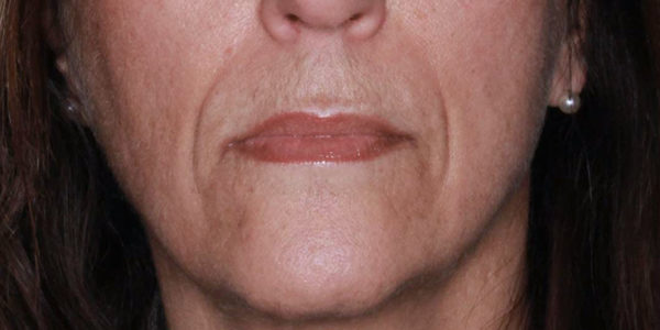 Before and after photos - Remove Lines Around the Mouth Called Parenthesis or Nasal Label Folds