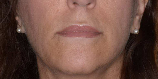 Before and after photos - Remove Lines Around the Mouth Called Parenthesis or Nasal Label Folds