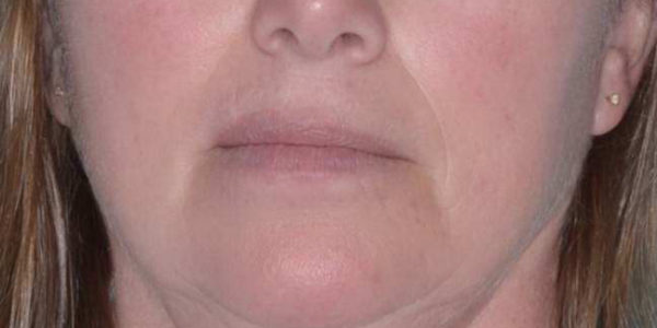 Before and after photos - Treat Facial Redness & Rosacea