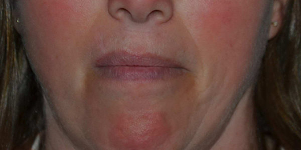 Before and after photos - Treat Facial Redness & Rosacea