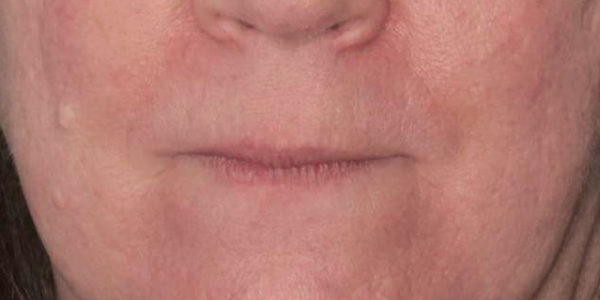 Before and after photos - Treat Facial Veins