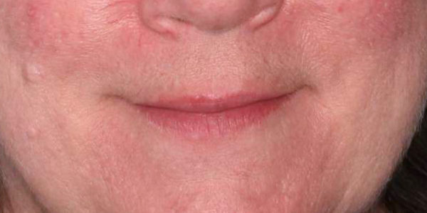 Before and after photos - Treat Facial Veins