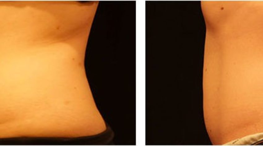 Coolsculpting - Timeless Skin Solutions